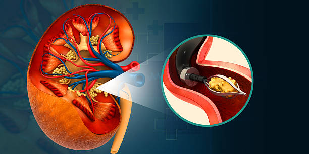 Best Kidney stone Treatment in Shivaji Park
